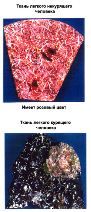 легкие курильщика